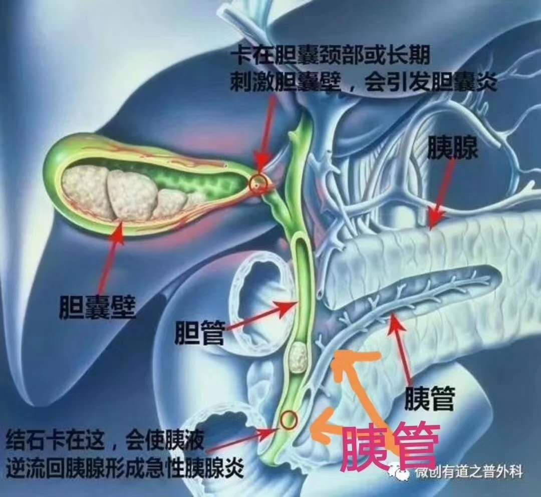 不开刀十二指肠镜下取出胰管结石